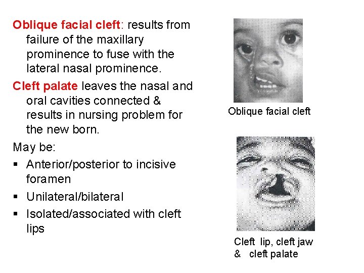 Oblique facial cleft: results from failure of the maxillary prominence to fuse with the