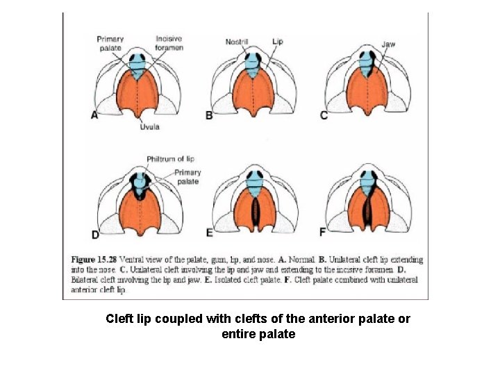 Cleft lip coupled with clefts of the anterior palate or entire palate 