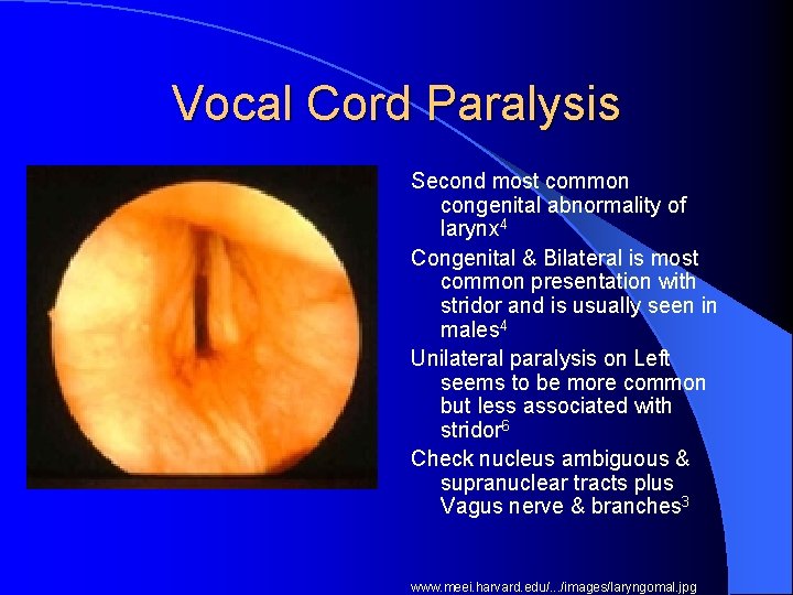 Vocal Cord Paralysis Second most common congenital abnormality of larynx 4 Congenital & Bilateral