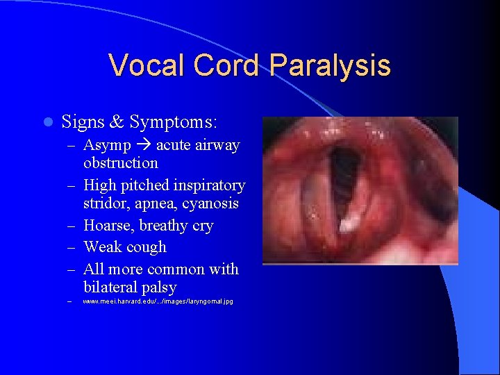 Vocal Cord Paralysis l Signs & Symptoms: – Asymp acute airway – – –