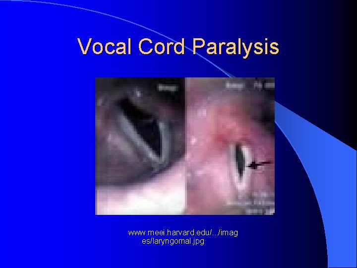 Vocal Cord Paralysis www. meei. harvard. edu/. . . /imag es/laryngomal. jpg 