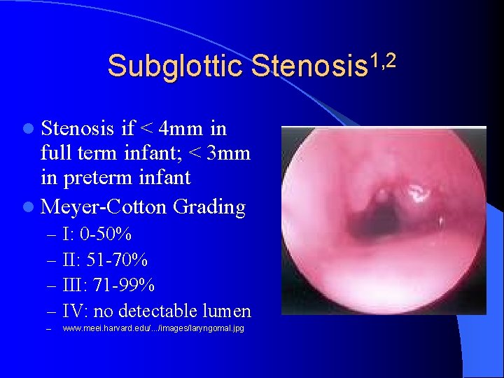 Subglottic Stenosis 1, 2 l Stenosis if < 4 mm in full term infant;