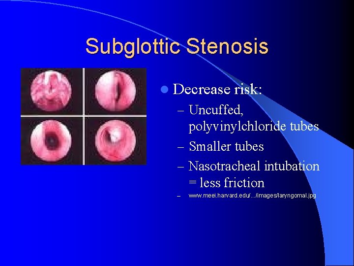 Subglottic Stenosis l Decrease risk: – Uncuffed, polyvinylchloride tubes – Smaller tubes – Nasotracheal