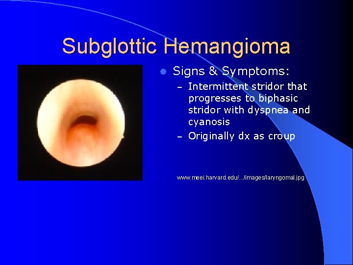 Subglottic Hemangioma l Signs & Symptoms: – Intermittent stridor that progresses to biphasic stridor
