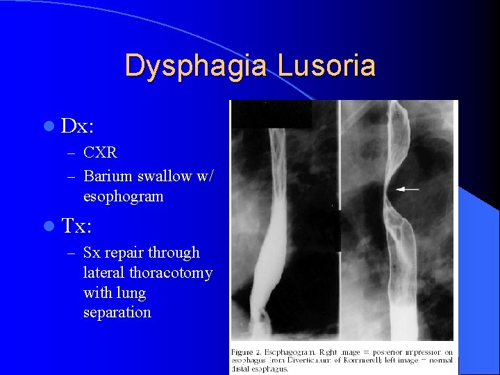 Dysphagia Lusoria l Dx: – CXR – Barium swallow w/ esophogram l Tx: –