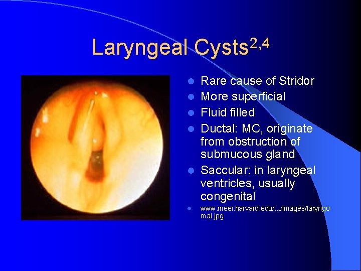 Laryngeal Cysts 2, 4 l l l Rare cause of Stridor More superficial Fluid