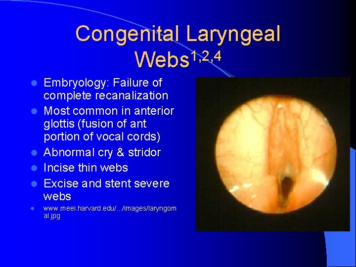 Congenital Laryngeal Webs 1, 2, 4 l l l Embryology: Failure of complete recanalization