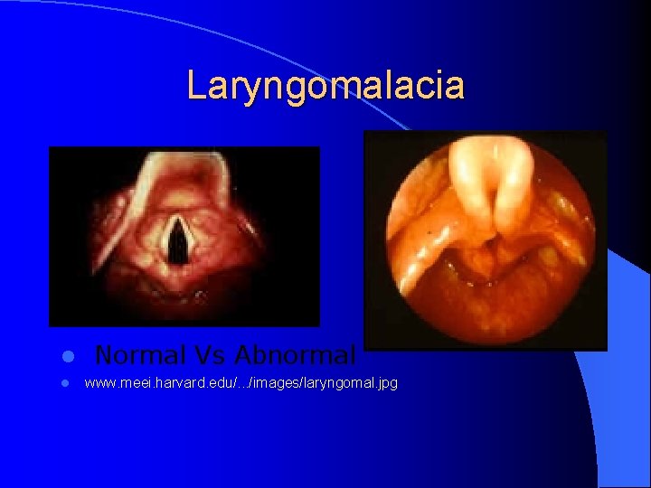 Laryngomalacia l l Normal Vs Abnormal www. meei. harvard. edu/. . . /images/laryngomal. jpg