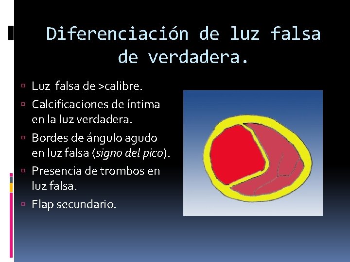 Diferenciación de luz falsa de verdadera. Luz falsa de >calibre. Calcificaciones de íntima en