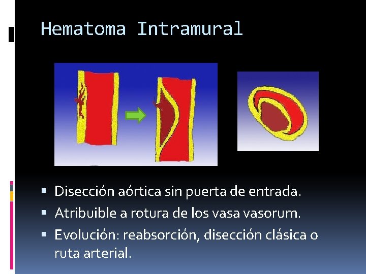 Hematoma Intramural Disección aórtica sin puerta de entrada. Atribuible a rotura de los vasa