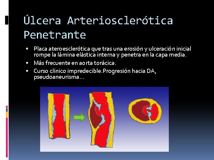 Úlcera Arteriosclerótica Penetrante Placa ateroesclerótica que tras una erosión y ulceración inicial rompe la