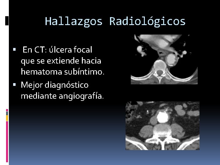 Hallazgos Radiológicos En CT: úlcera focal que se extiende hacia hematoma subíntimo. Mejor diagnóstico