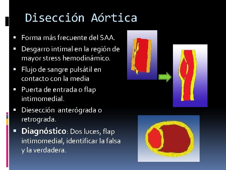 Disección Aórtica Forma más frecuente del SAA. Desgarro intimal en la región de mayor