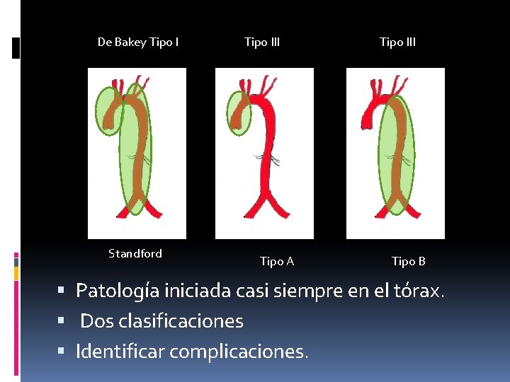 De Bakey Tipo I Standford Tipo III Tipo A Tipo III Tipo B Patología