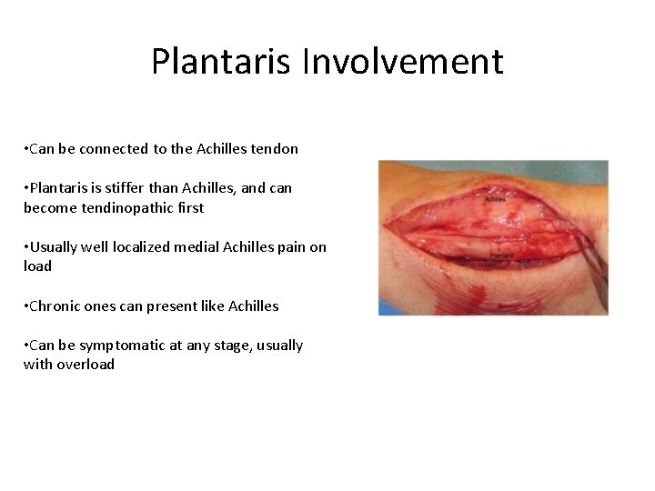Plantaris Involvement • Can be connected to the Achilles tendon • Plantaris is stiffer