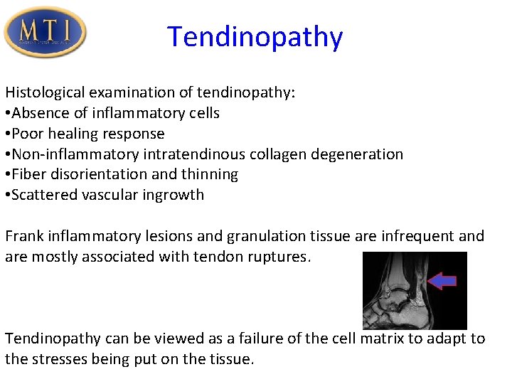 Tendinopathy Histological examination of tendinopathy: • Absence of inflammatory cells • Poor healing response