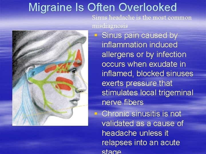 Migraine Is Often Overlooked Sinus headache is the most common misdiagnosis § Sinus pain