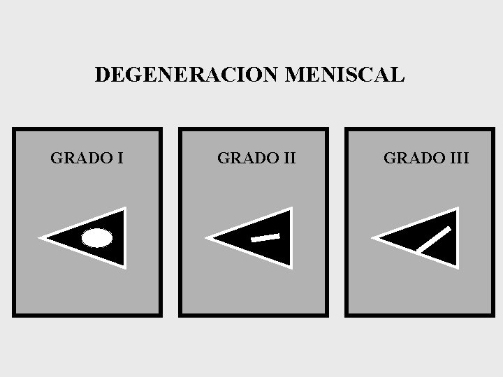 DEGENERACION MENISCAL GRADO III 