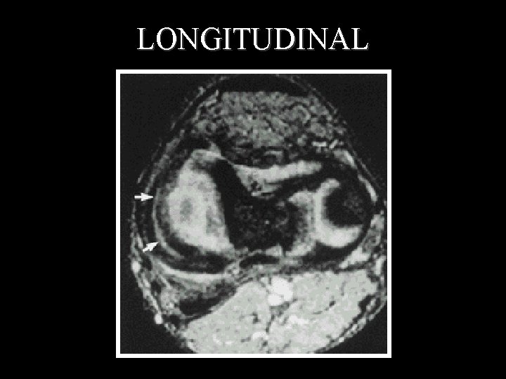 LONGITUDINAL 