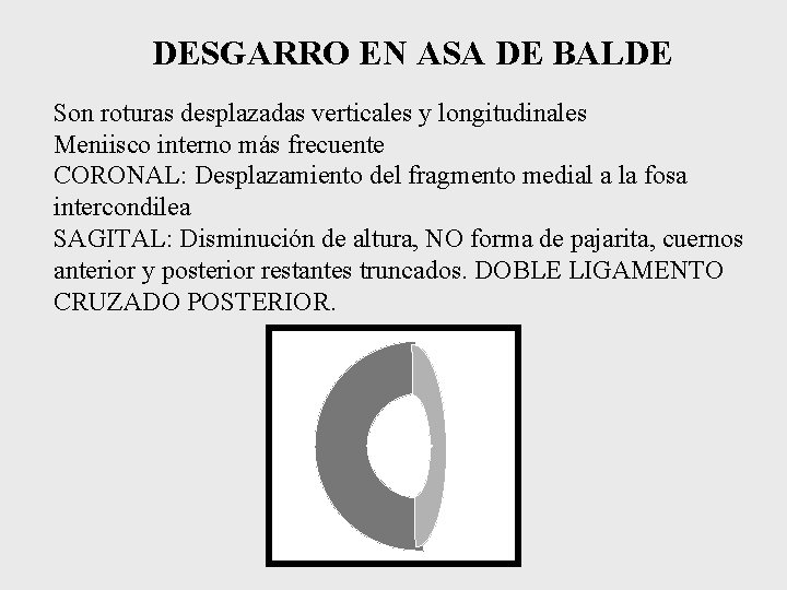 DESGARRO EN ASA DE BALDE Son roturas desplazadas verticales y longitudinales Meniisco interno más