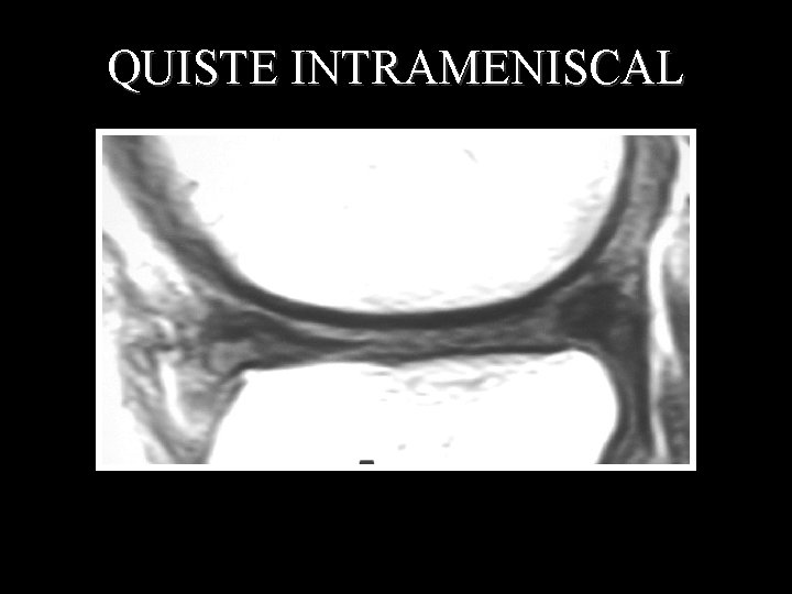 QUISTE INTRAMENISCAL 