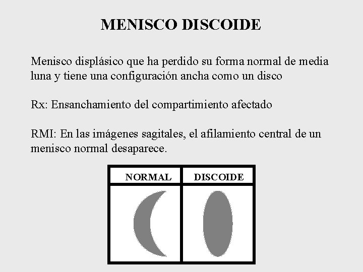 MENISCO DISCOIDE Menisco displásico que ha perdido su forma normal de media luna y