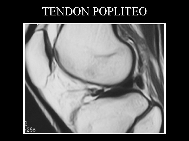 TENDON POPLITEO 