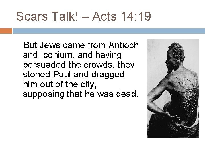 Scars Talk! – Acts 14: 19 But Jews came from Antioch and Iconium, and Scars Talk! – Acts 14: 19 But Jews came from Antioch and Iconium, and