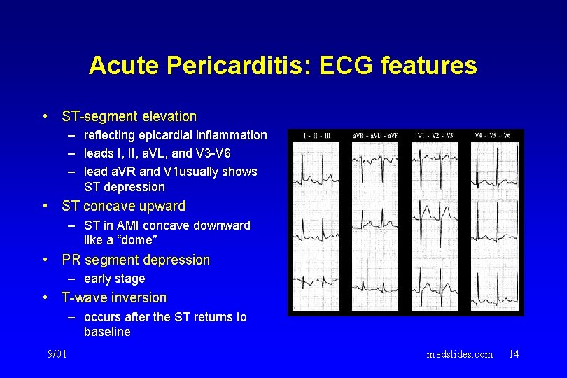 Acute Pericarditis: ECG features • ST-segment elevation – reflecting epicardial inflammation – leads I,