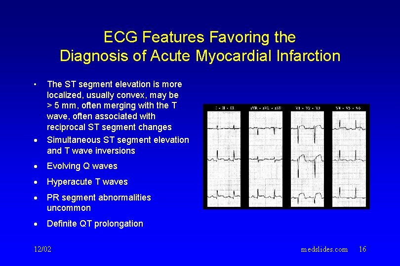 ECG Features Favoring the Diagnosis of Acute Myocardial Infarction • · The ST segment ECG Features Favoring the Diagnosis of Acute Myocardial Infarction • · The ST segment