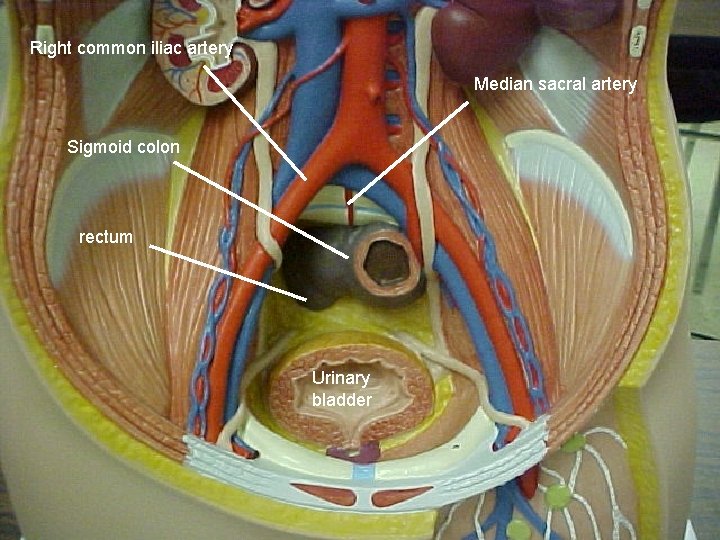 Right common iliac artery Median sacral artery Sigmoid colon rectum Urinary bladder 