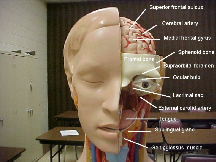 Superior frontal sulcus Cerebral artery Medial frontal gyrus Sphenoid bone Frontal bone Supraorbital foramen