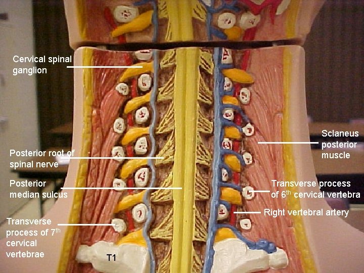 Cervical spinal ganglion Sclaneus posterior muscle Posterior root of spinal nerve Posterior median sulcus