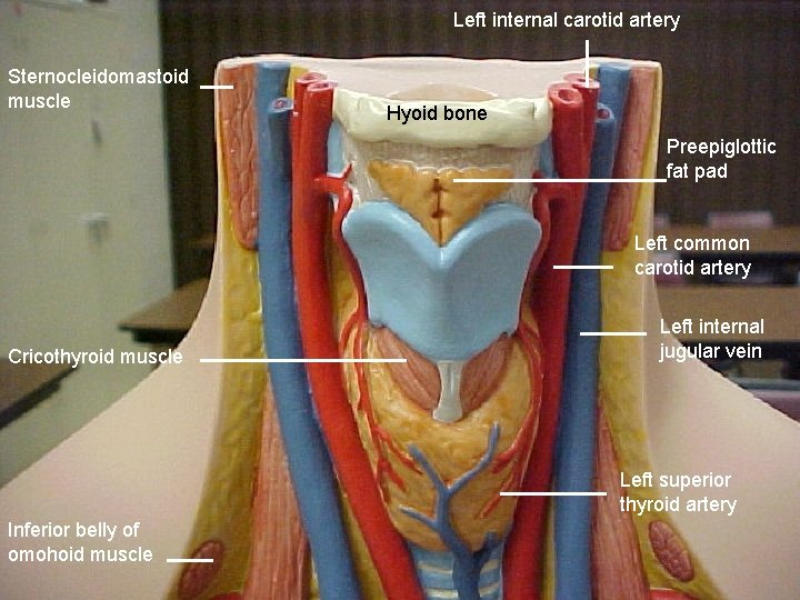 Left internal carotid artery Sternocleidomastoid muscle Hyoid bone Preepiglottic fat pad Left common carotid