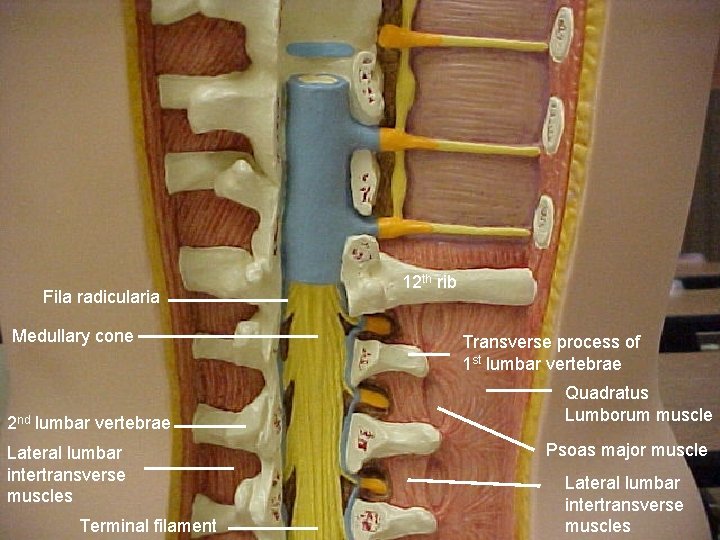 Fila radicularia Medullary cone 2 nd lumbar vertebrae Lateral lumbar intertransverse muscles Terminal filament