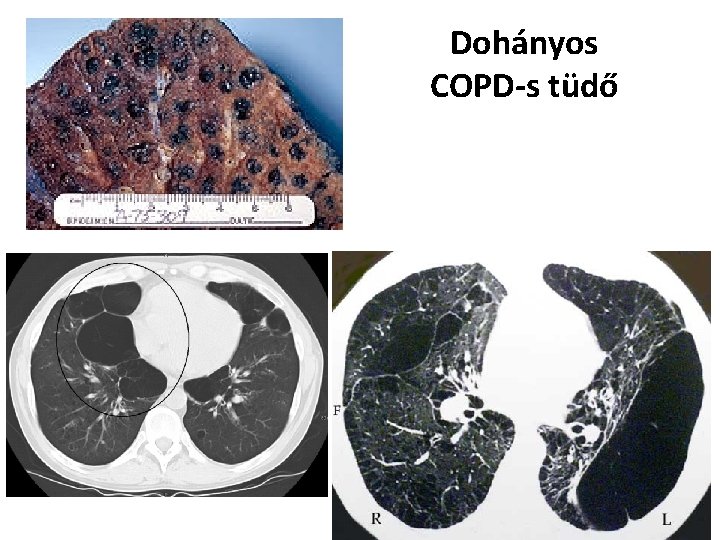 Dohányos COPD-s tüdő 