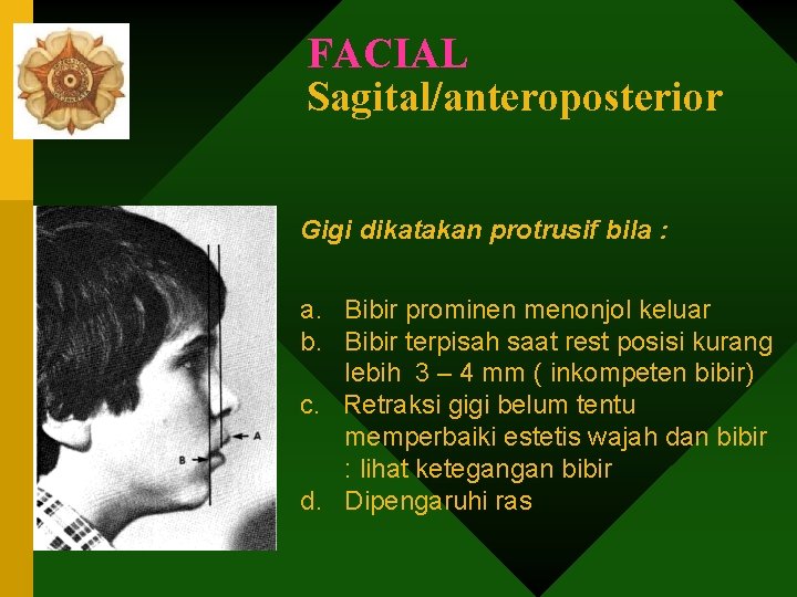 FACIAL Sagital/anteroposterior Gigi dikatakan protrusif bila : a. Bibir prominen menonjol keluar b. Bibir