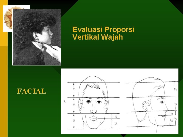 Evaluasi Proporsi Vertikal Wajah FACIAL 