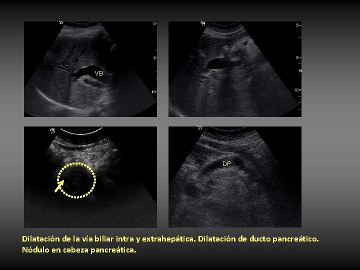 VB DP Dilatación de la vía biliar intra y extrahepática. Dilatación de ducto pancreático. VB DP Dilatación de la vía biliar intra y extrahepática. Dilatación de ducto pancreático.