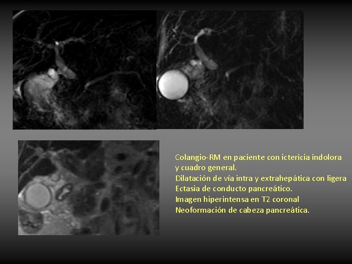 Colangio-RM en paciente con ictericia indolora y cuadro general. Dilatación de vía intra y Colangio-RM en paciente con ictericia indolora y cuadro general. Dilatación de vía intra y