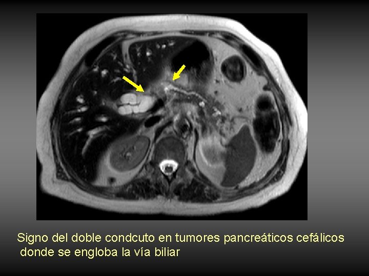 Signo del doble condcuto en tumores pancreáticos cefálicos donde se engloba la vía biliar Signo del doble condcuto en tumores pancreáticos cefálicos donde se engloba la vía biliar