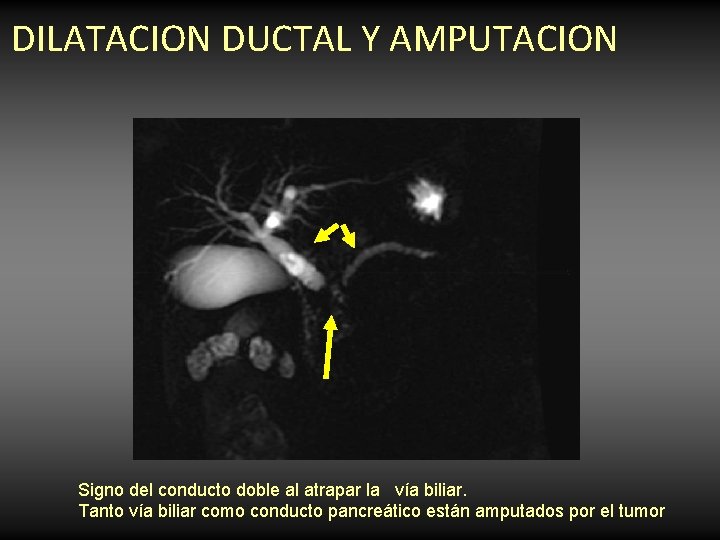 DILATACION DUCTAL Y AMPUTACION Signo del conducto doble al atrapar la vía biliar. Tanto DILATACION DUCTAL Y AMPUTACION Signo del conducto doble al atrapar la vía biliar. Tanto