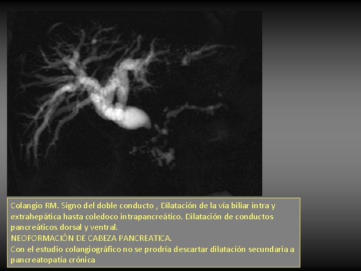 Colangio RM. Signo del doble conducto , Dilatación de la vía biliar intra y Colangio RM. Signo del doble conducto , Dilatación de la vía biliar intra y