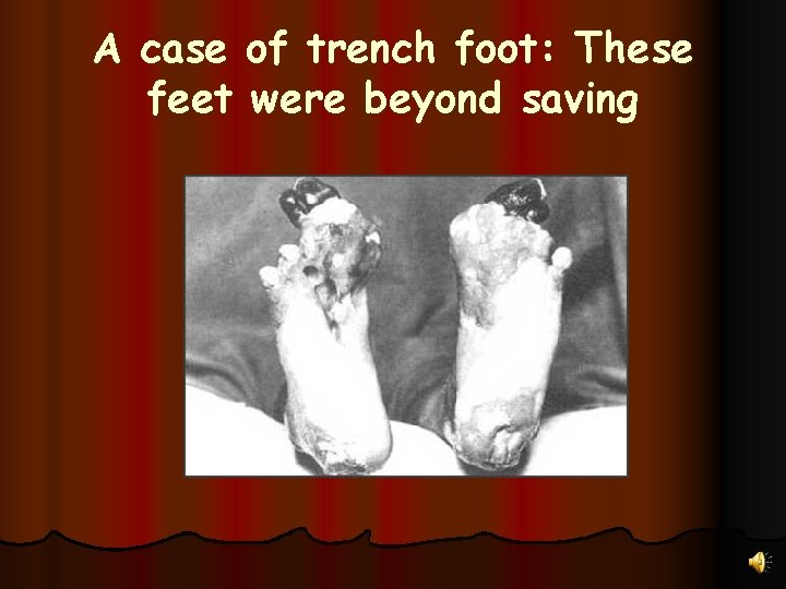 A case of trench foot: These feet were beyond saving 