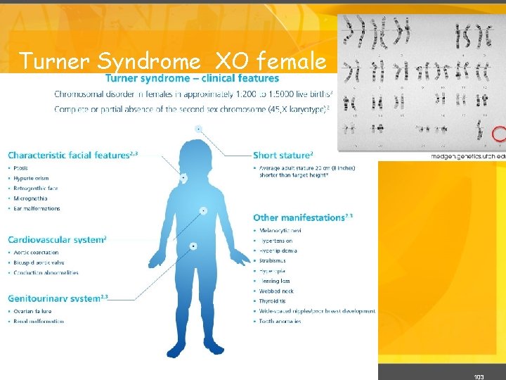 Turner Syndrome XO female 103 