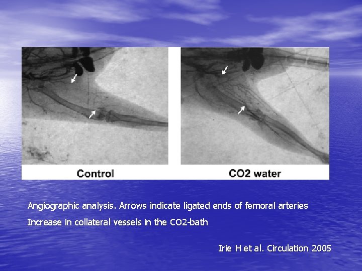 Angiographic analysis. Arrows indicate ligated ends of femoral arteries Increase in collateral vessels in