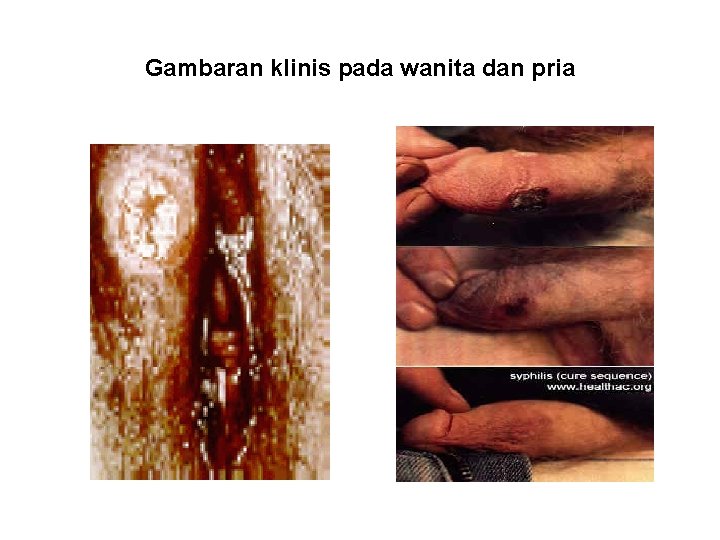 Gambaran klinis pada wanita dan pria Gambaran klinis pada wanita dan pria
