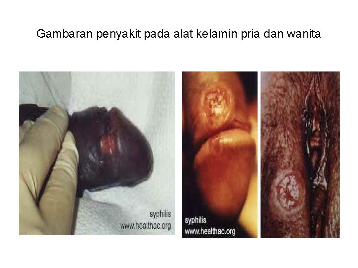 Gambaran penyakit pada alat kelamin pria dan wanita Gambaran penyakit pada alat kelamin pria dan wanita