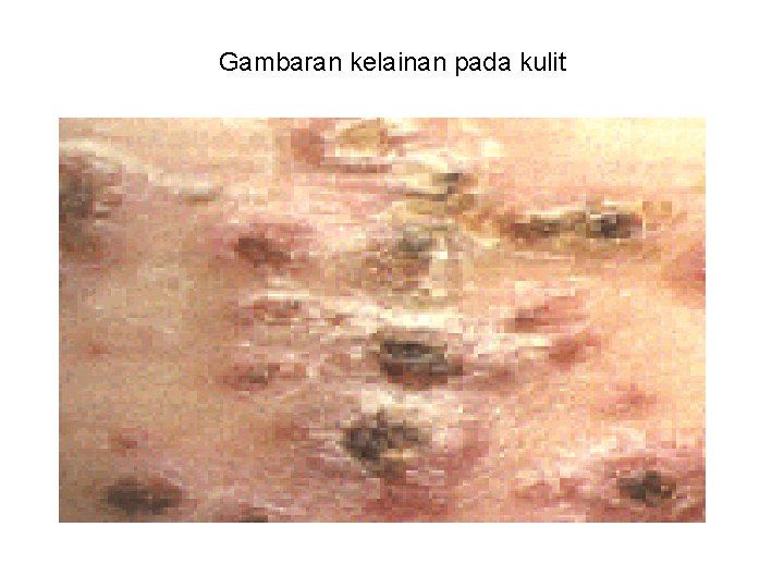 Gambaran kelainan pada kulit Gambaran kelainan pada kulit