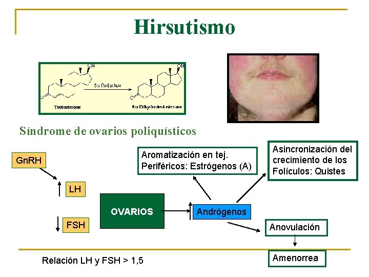 Hirsutismo Síndrome de ovarios poliquísticos Aromatización en tej. Periféricos: Estrógenos (A) Gn. RH Asincronización